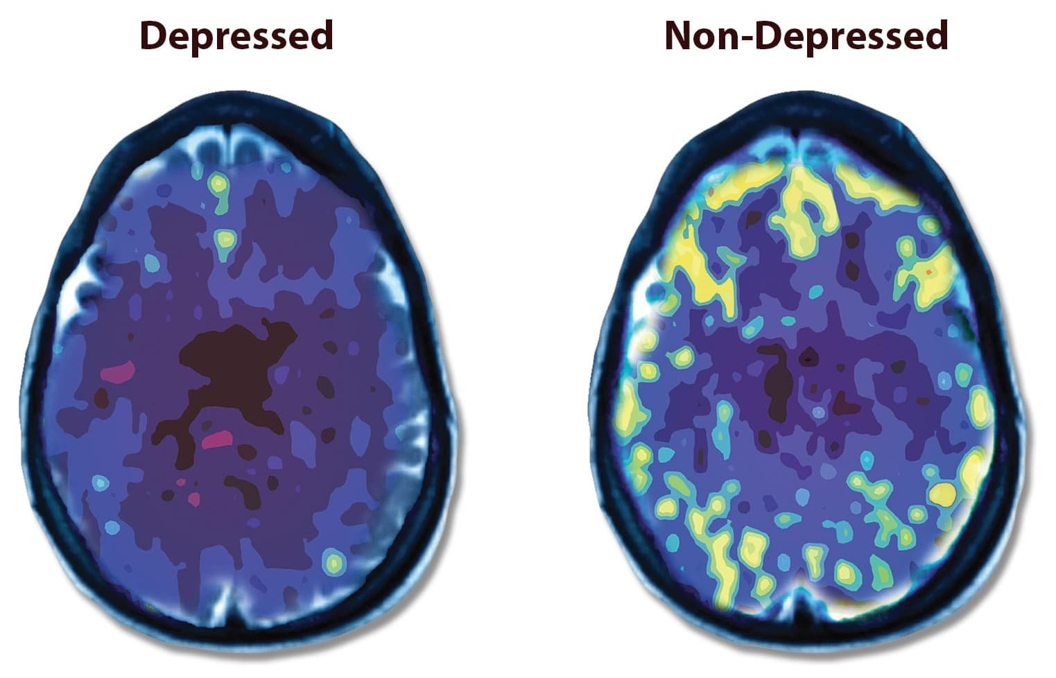 Side-by-side brain scan images comparing depressed and non-depressed brain activity